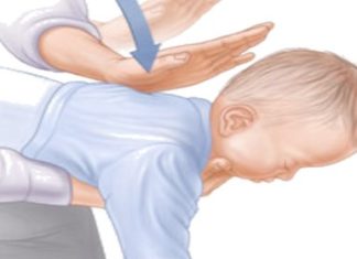 manovra di disostruzione pediatrica