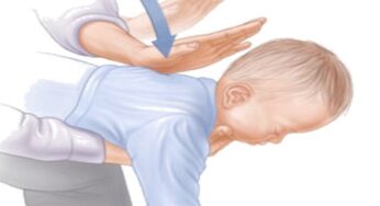 La manovra di disostruzione pediatrica: un piccolo gesto per salvare una vita