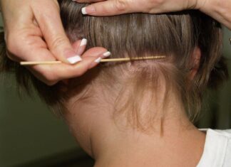 eliminare i pidocchi